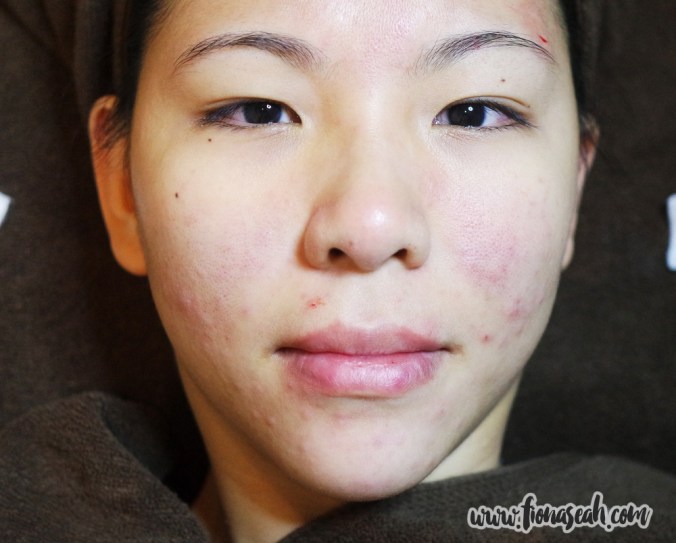 My face after extraction - red and blotchy as I had expected. But it wasn't as aggravated as I had imagined it to be.