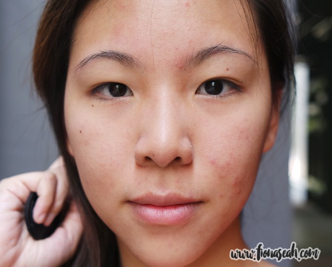 My face before the treatment. You can literally see the flakes around my nose.