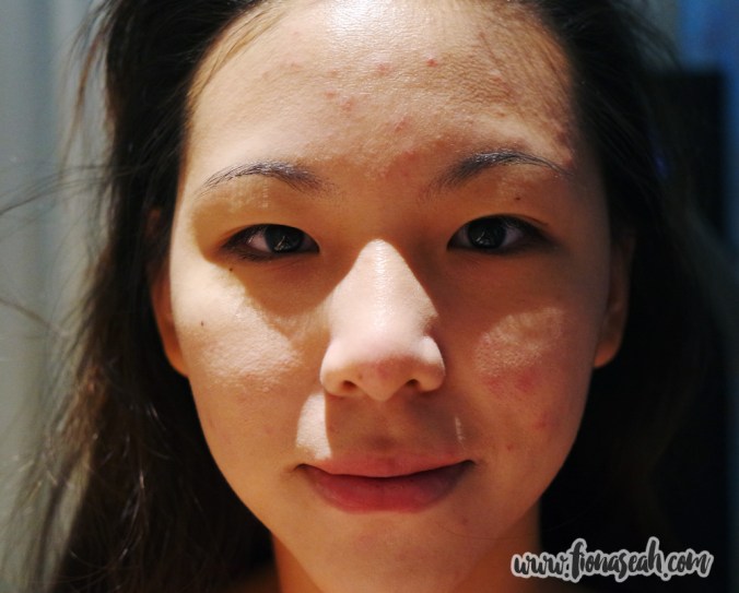 Face not as red and blotchy anymore, eh?