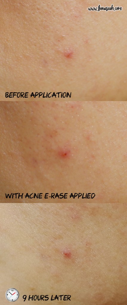 My pimple had clearly shrunk and dried out after application!