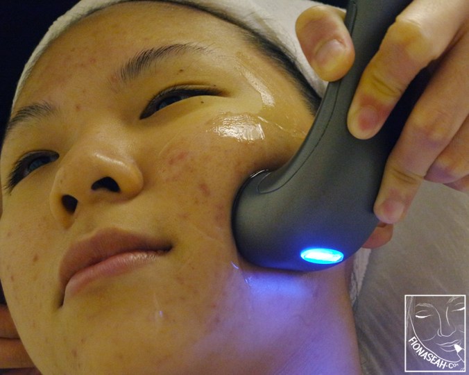 And then to the cheekbone