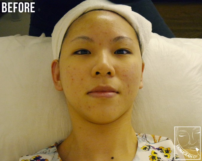 Before undergoing Sygmalift. This was the state of my face in November 2017 - so horribly sad! So apart from Sygmalift, Dr Ee also recommended a series of acne treatments for me to try and these experiences will be covered in my next post!