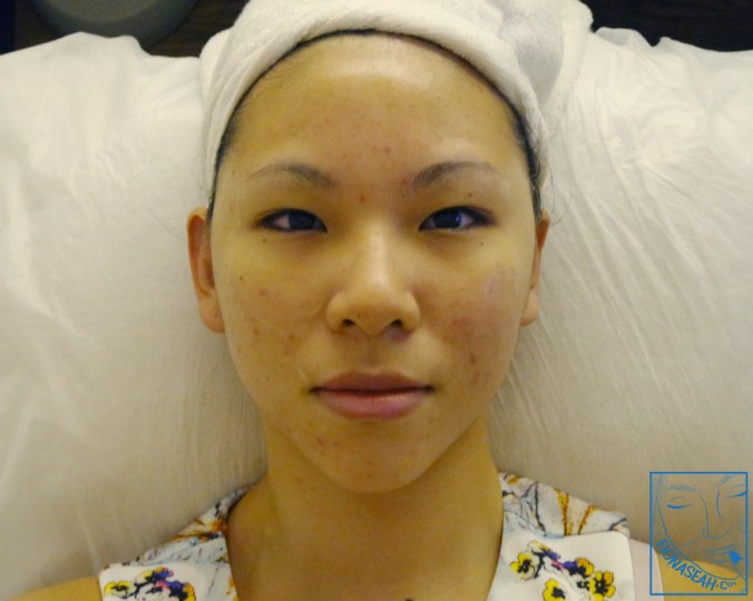 Done! My face felt a little swollen after the procedure but it was just temporary