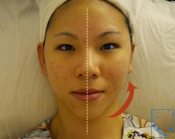 Notice that my face is slightly lifted on the right now?