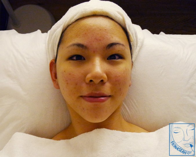 Taadaah! My horrible skin!