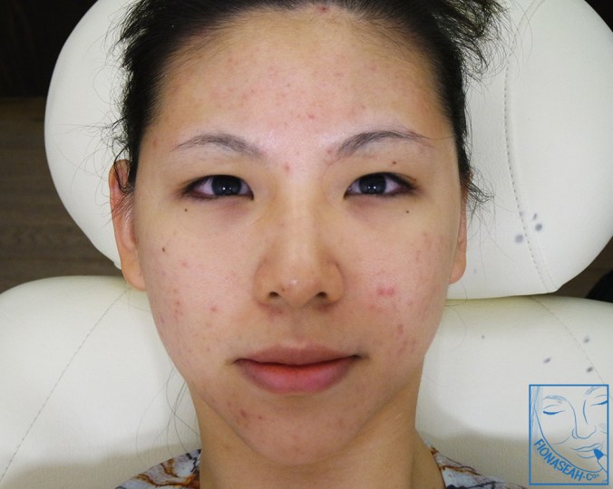 Post-laser. Eyes turned red from the sudden change in lighting haha