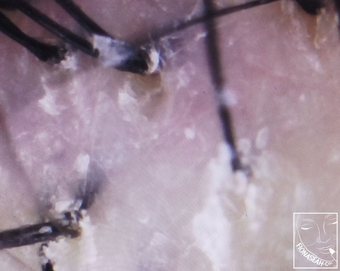 My poor scalp trying to keep my hair intact :(