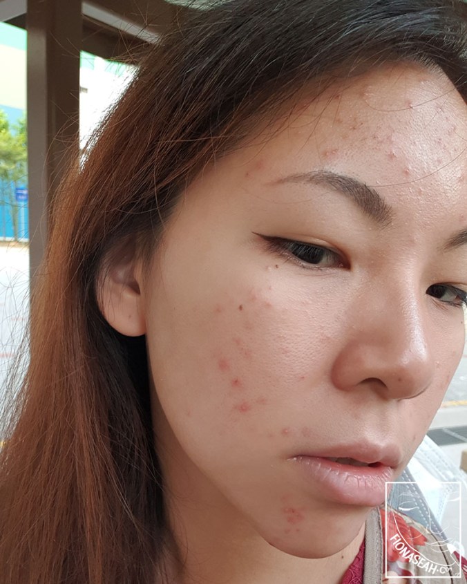 (Day 2, pre-appointment condition) The other side