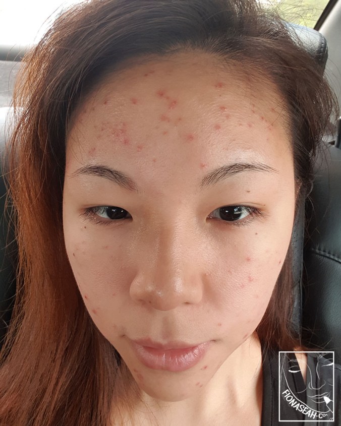 Day 3. Zits turning into scabs!