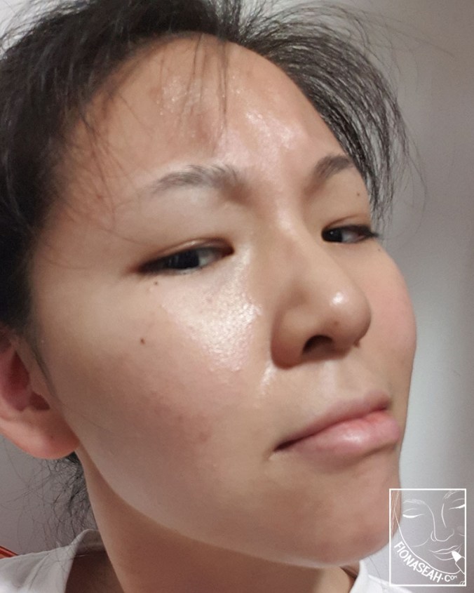 (Sorry for the blur quality) Almost entirely gone on Day 8!