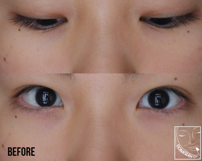 Eyelids: Now you see me, now you don't