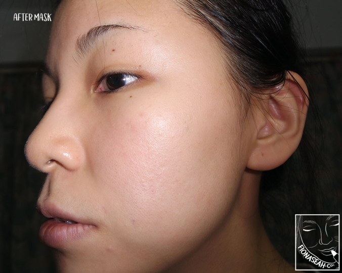 After removal of mask - side profile