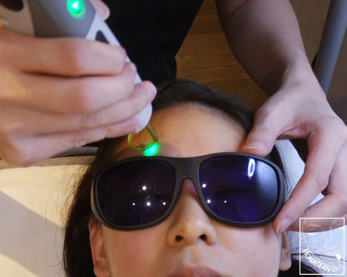 The most uncomfortable part of the procedure because I could feel some tingling sensation.. but it was bearable.