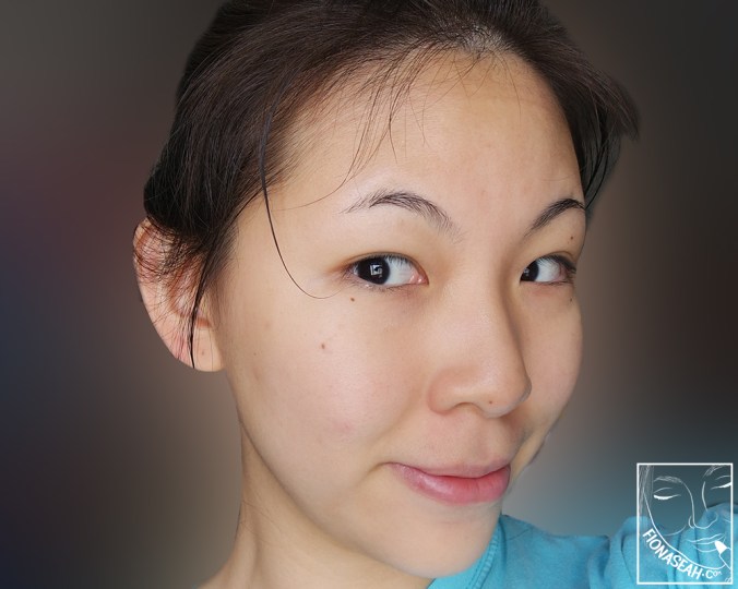 The day after my first session! Still some visible blemishes but they weren't there for long!