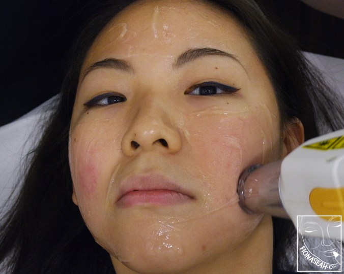 The cooling gel allowed my face to cool before laser application took place...