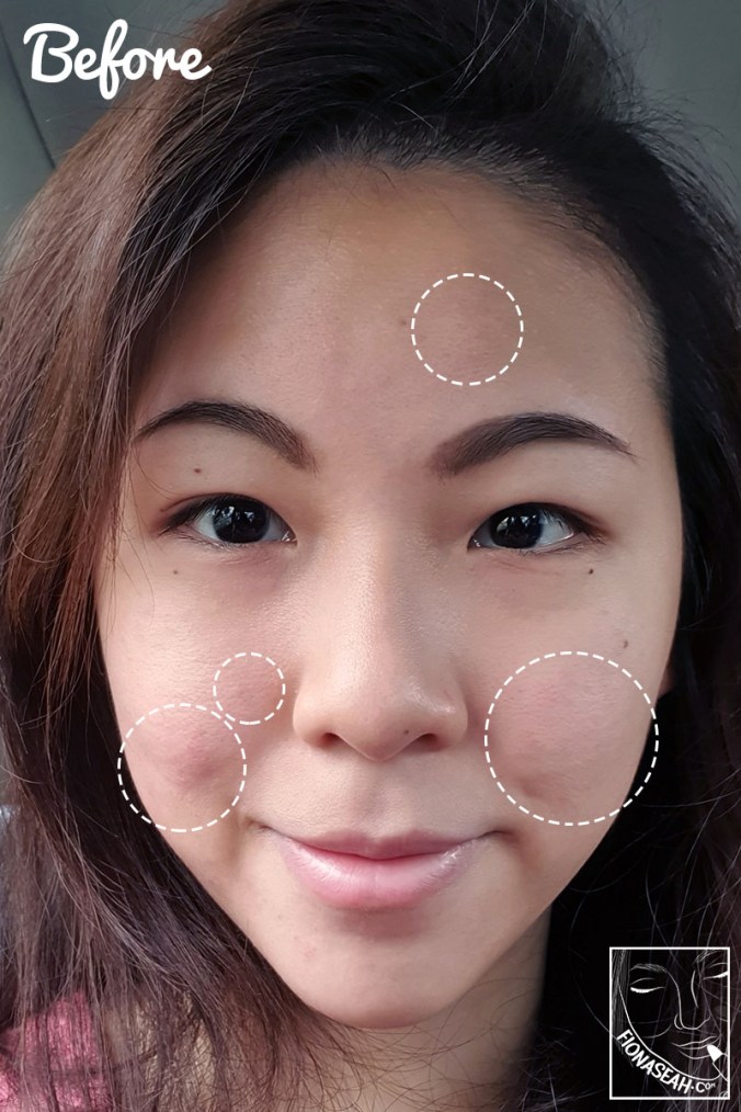 My face, up close. Flare-ups as circled.